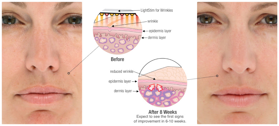 Have you heard about our new Superhero modality? It's called Light Stim. Tucson DMK Incandescent Skin Spa