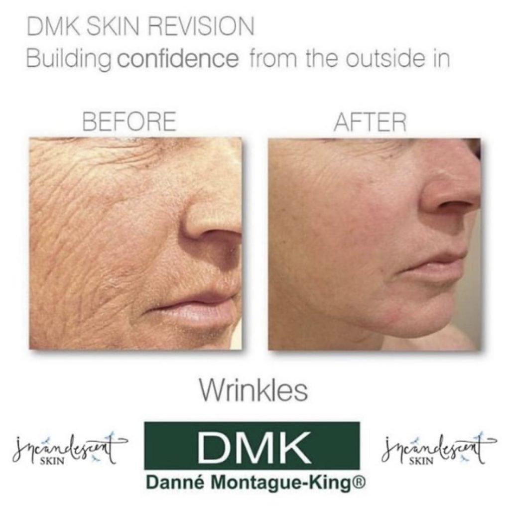 DMK Skin Revision, building confidence from the outside in, before and afters, no more wrinkles. 