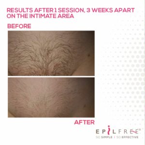 EpilFree Permanent Hair Removal Medical Grade Skincare and